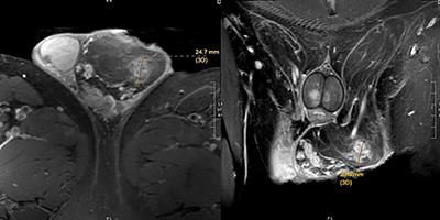 Spindle Cell Lipoma of the Spermatic Cord: A Case Presentation and Literature Review of a Urologic Rarity and Radiologic Mimic of Malignant Liposarcoma